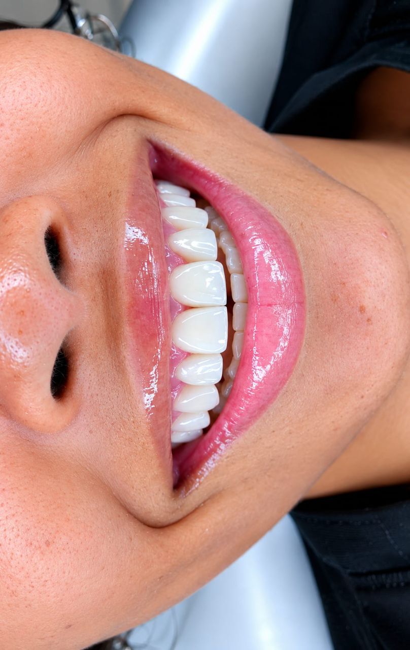 Diseño de sonrisa