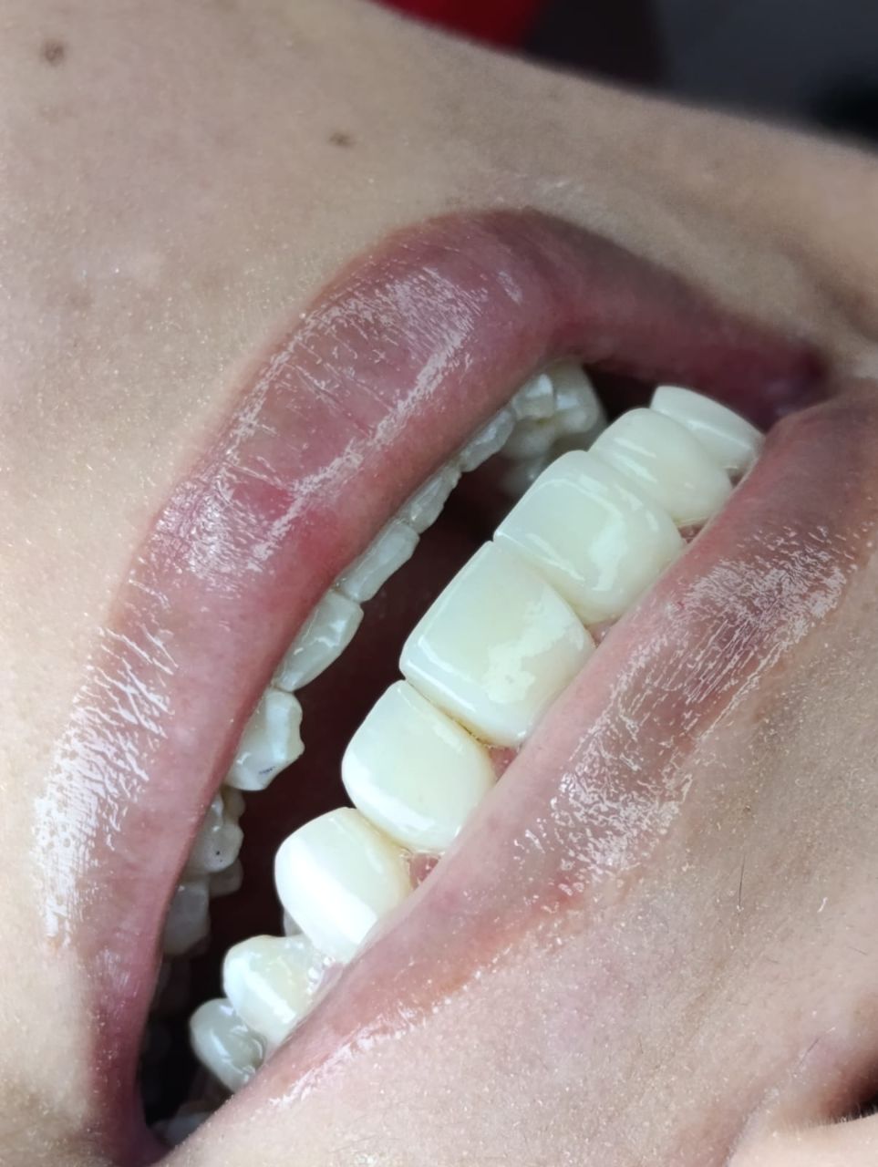 Carillas dentales