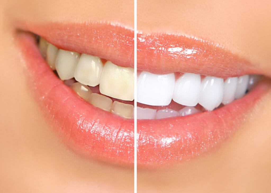 Blanqueamiento Dental