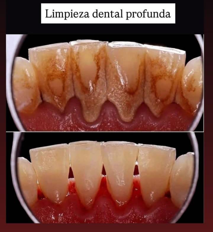 Profilaxis y Limpieza